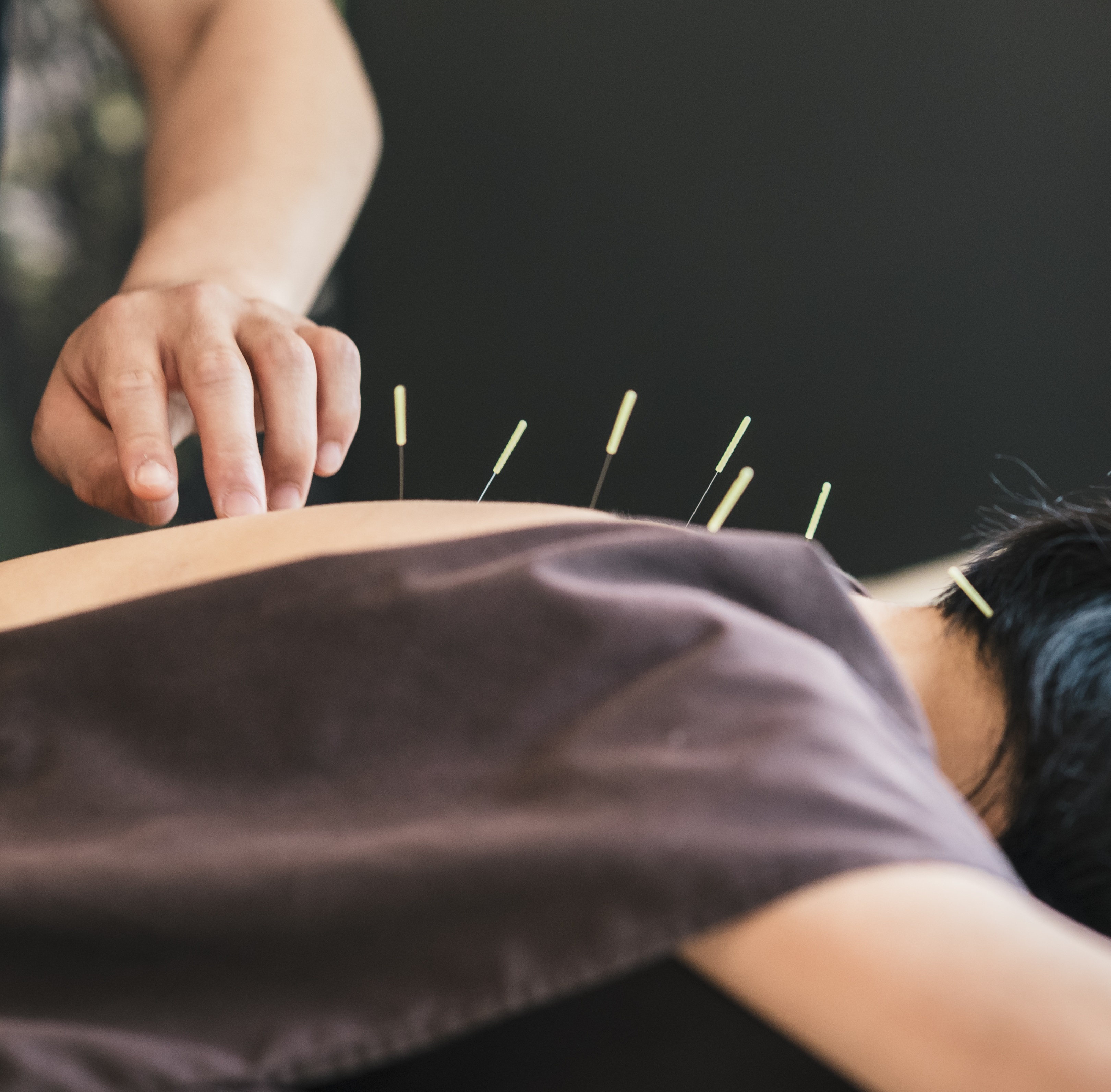 Acupuncture